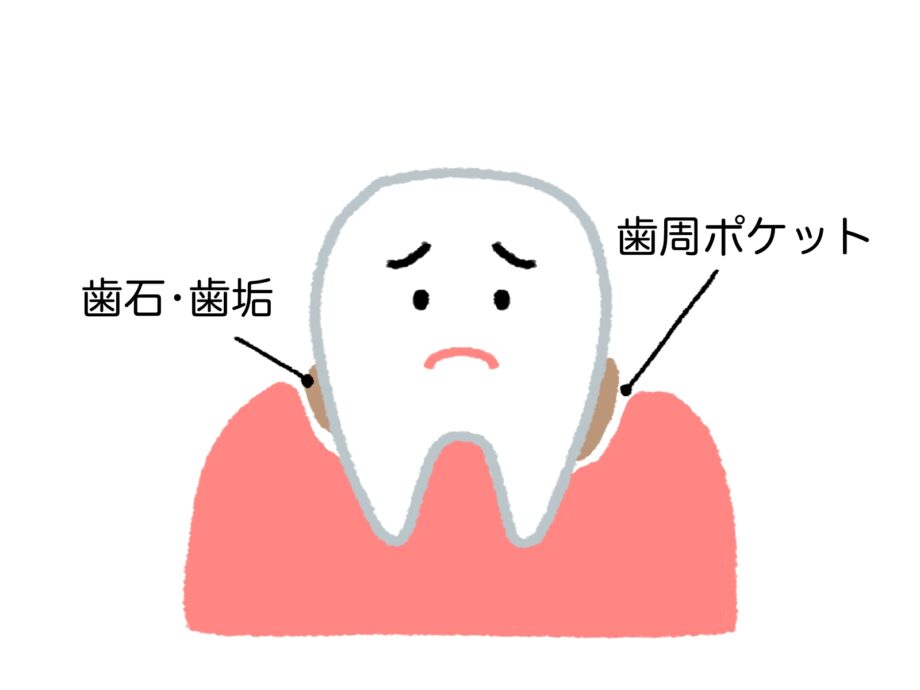 歯周ポケット